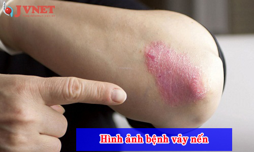 bệnh vảy nến cho đi XKLĐ Nhật Bản được không 